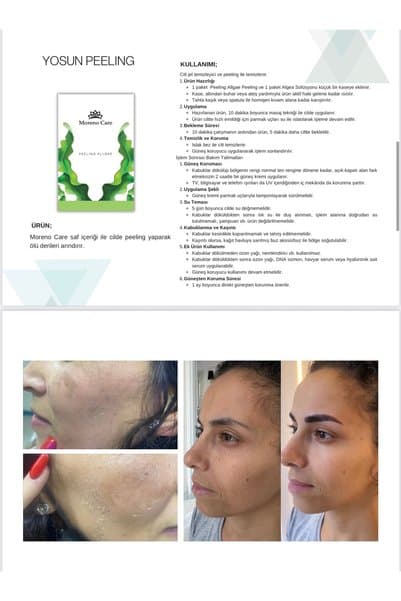 Moreno Care yosun peelin 10 kullanım